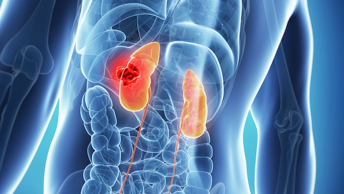 Malekidneys-cancer