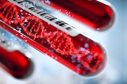University Of Cambridge Project Nimble Genomics Discusses Brain Cancer Liquid Biopsy