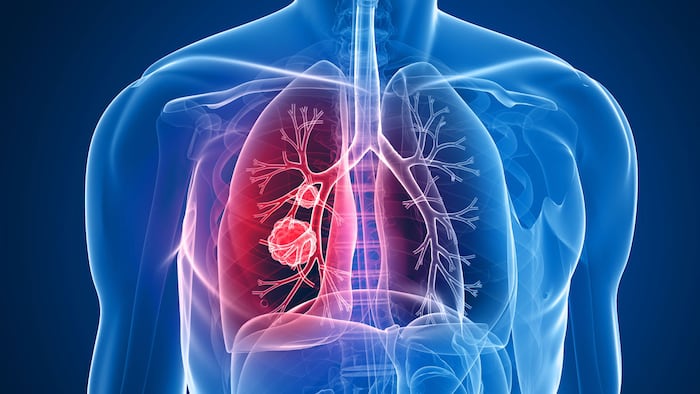 Lung Cancer